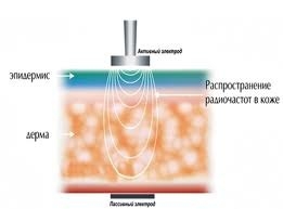 Радиочастотный лифтинг кожи (омоложение)